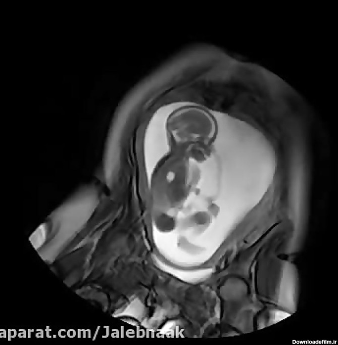 حرکت جنین در هفته 24 ام در شکم مادر (ماه ششم) - Fetal movement