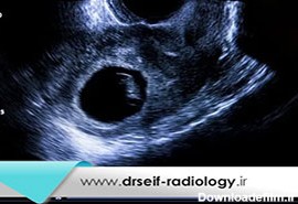 در انواع سونوگرافی های بارداری چه چیزهایی بررسی می شود؟