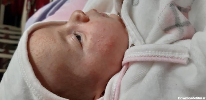 ایا شیر خشک باعث جوش زدن صورت نوزاد میشود؟
