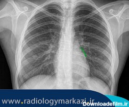 عکس رادیولوژی قفسه سینه | هزینه رادیولوژی قفسه سینه
