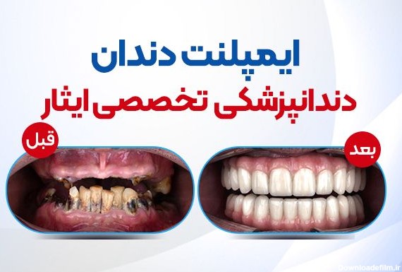 ايمپلنت و ارتودنسي و كامپوزيت دندان