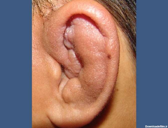 چگونه هماتوم لاله گوش (گوش گل کلمی) درمان می شود؟ علائم آن چیست؟