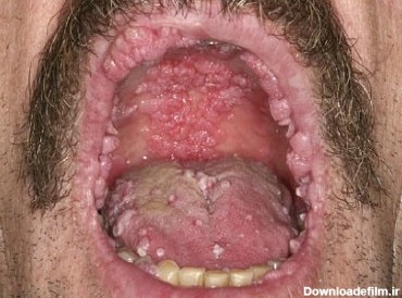 زگیل دهانی (زگیل تناسلی در دهان و گلو) + عکس و نحوه درمان