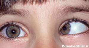 علل و درمان انحراف چشم (لوچی یا استرابیسم)