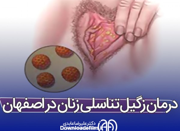 بهترین راه درمان زگیل تناسلی زنان در اصفهان | بهترین متخصص زگیل ...