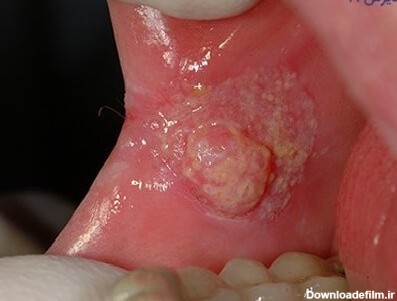 زگیل دهانی چیست؟ علل، علائم و درمان زگیل دهانی