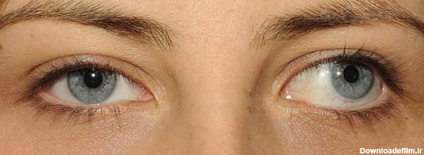 درمان انحراف چشم یا استرابیسم در بزرگسالان - جراح متخصص زیبایی چشم ...
