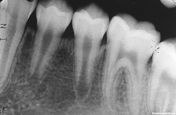 تشخیص پوسیدگی دندان از روی عکس رادیولوژی - رادیولوژی دکتر مشفقی