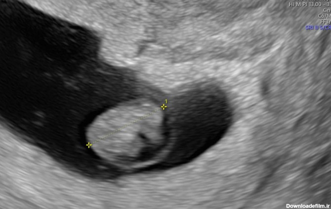 در این تصویر می‌توانید سونوگرافی هفته 7 بارداری را مشاهده کنید.
