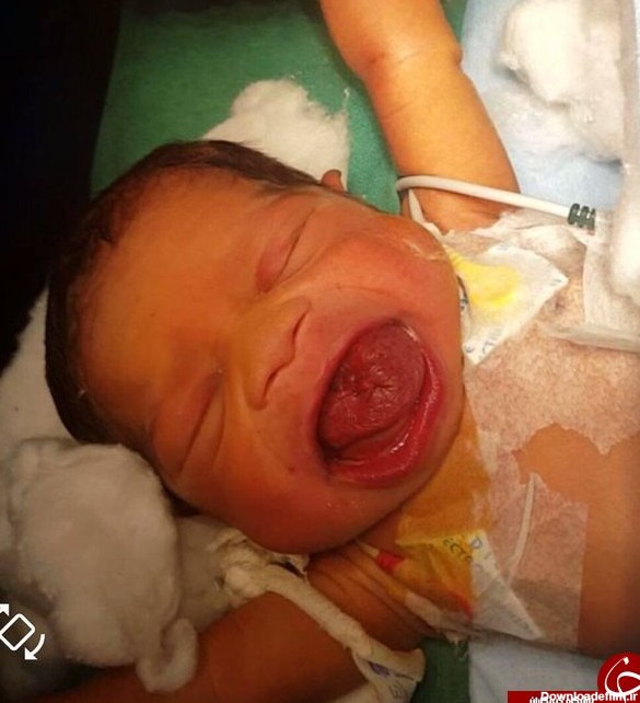 نوزادی که با یک زبان غول‌پیکر متولد شد!+ تصاویر