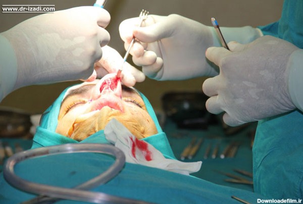 جراحی بینی چگونه انجام می شود؟ (عکس)
