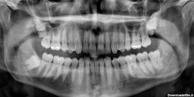 قیمت عکس رادیولوژی دهان و دندان، خطرات و عوارض آن در دوران بارداری