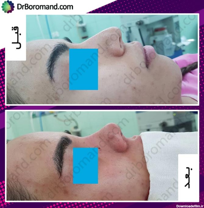 تصاویر قبل و بعد جراحی بینی در اتاق عمل - دکتر پیمان برومند