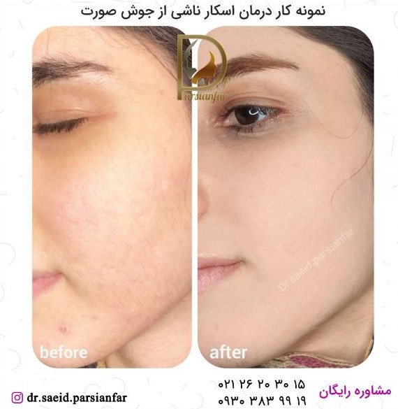 نمونه کار درمان اسکار توسط پزشک متخصص پوست و زیبایی تهران