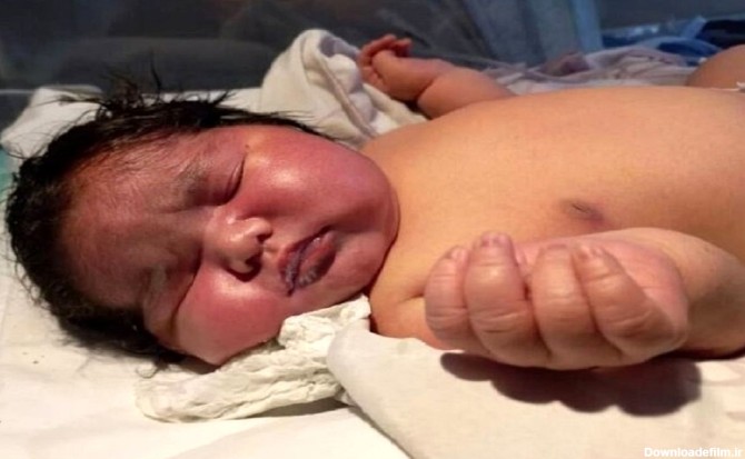 تولد یک نوزاد دختر با دُم 12 سانتیمتری + عکس