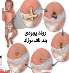 عفونت بند ناف نوزاد / علائم و علت عفونت /درمان عفونت ناف نوزادان ...