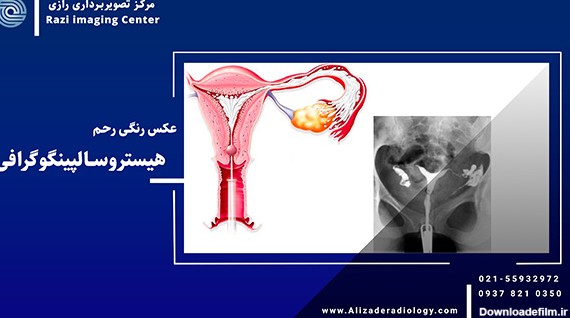 عکس رنگی رحم | هسیتروسالپینگوگرافی