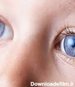 آیا لنزهای تماسی گزینه مناسبی برای کودکان هستند؟