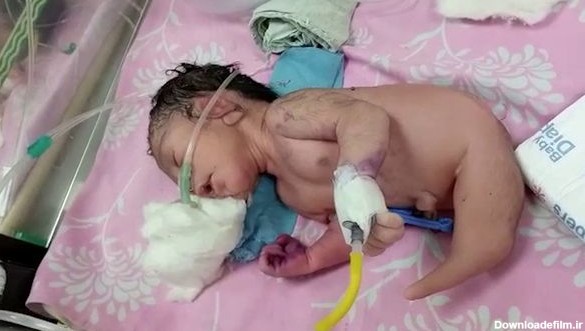 تولد یک نوزاد عجیب‌ الخلقه که به جای پا، دُم‌ دارد (+عکس)