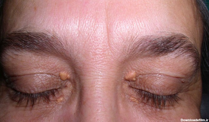 درمان و ازبین بردن چربی پلک چشم + علل و علائم | مجله دکتردکتر