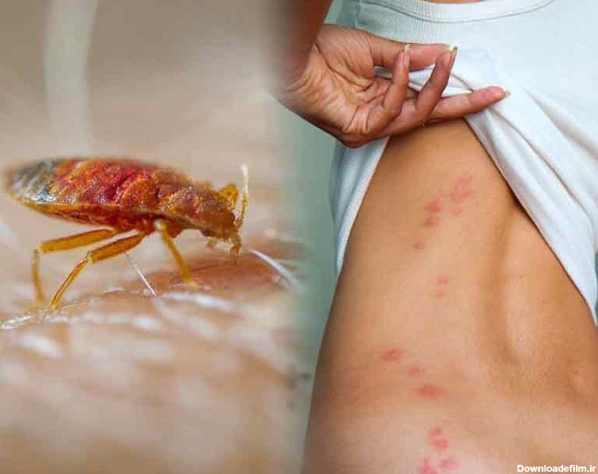 شرکت سمپاشی نگین دشت - گزش حشرات و راههای پیشگیری و درمان آن