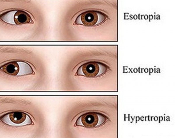 انحراف چشم (استرابیسم یا لوچی) - کلینیک چشم پزشکی آبان