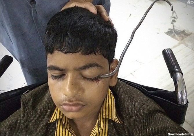 آخرین خبر | خارج‌کردن قلاب از چشم پسربچه هندی(۱۸+)