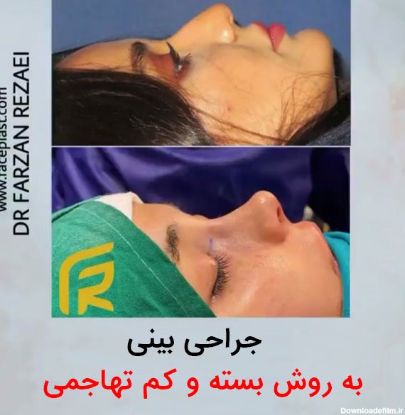 جراحی بینی بسته - دکتر فرزان رضایی
