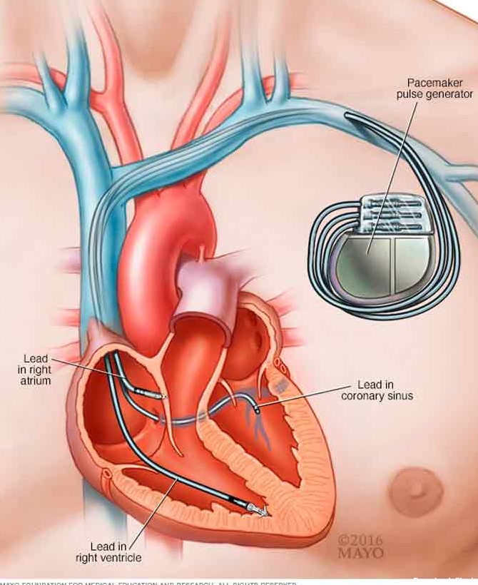 عوارض باتری قلب چیست؟ | کلینیک تخصصی قلب نگار مشهد
