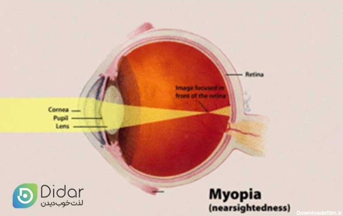 نزدیک بینی چشم چیست و چگونه درمان می شود؟ علائم و علت آن