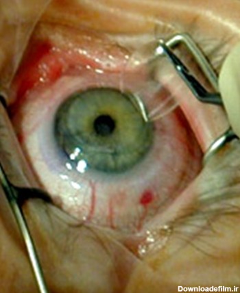 جراحی ليزیک چشم
