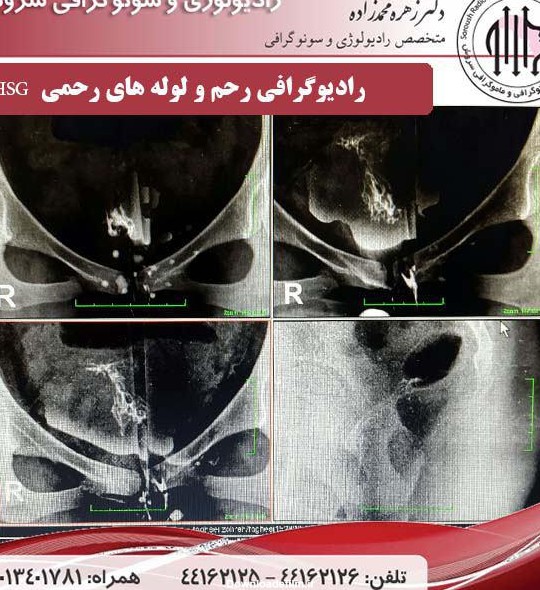 عکس رنگی از رحم تهرانپارس