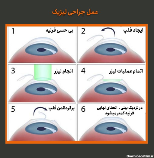 جراحی لیزیک چشم، کارایی، مزایا و معایب (بخش اول) - کلینیک چشم ...