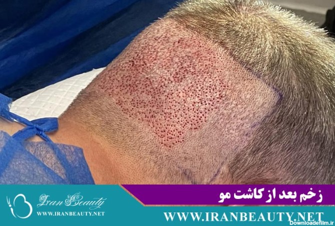 زخم های بعد از کاشت مو | علت و درمان - کلینیک ایران بیوتی
