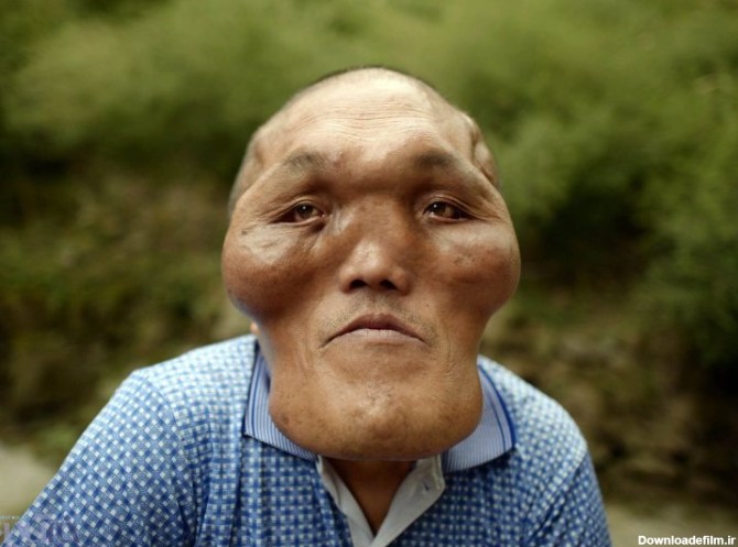 تصاویر | بیماری عجیب و غریب مرد چینی - خبرآنلاین