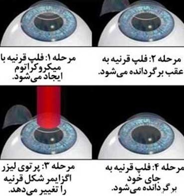 8 شرط عمل لیزیک چشم در شیراز + مزایا، مراقبت بعد و عوارض این عمل ...