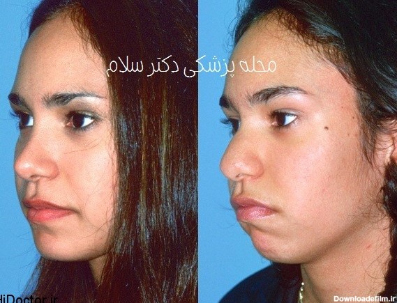 عکس تفاوت های ظاهری قبل و بعد از عمل جراحی زیبایی بینی :: وبلاگ ...