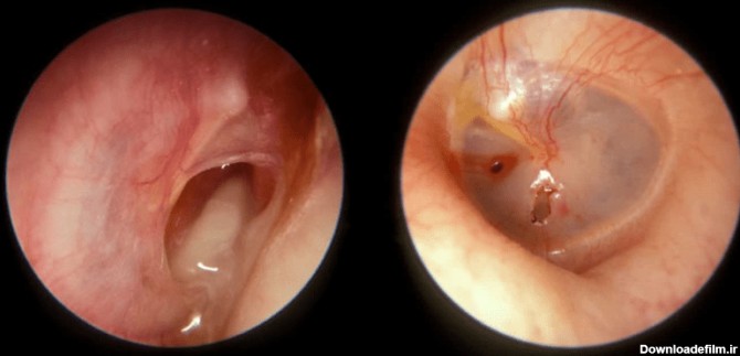 پارگی پرده گوش | علائم و درمان پارگی پرده گوش - کلینیک سمعک ساعی