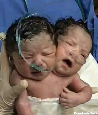 تولد عجیب یک نوزاد در مکزیک با دو سر/ عکس - خبرآنلاین