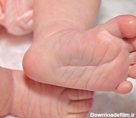 علت و درمان کج شدن پاها در نوزادان + روش تشخیص