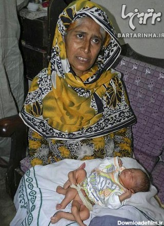تولد نوزاد شش پا در پاکستان+ عکس