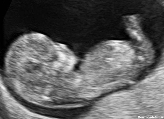 تصاویر سونوگرافی سه ماهه اول جنین - هفته هفتم تا دوازدهم در بهترین ...