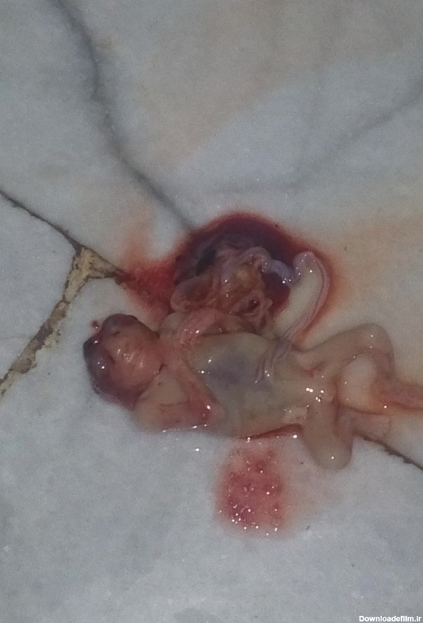 عکس بچه سقط شده یک ماهه
