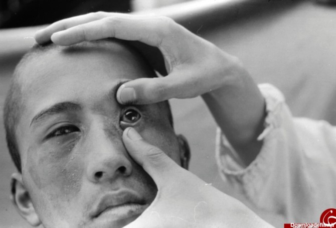 چشم ژاپنی ها بعد از بمب هیروشیما +تصاویر