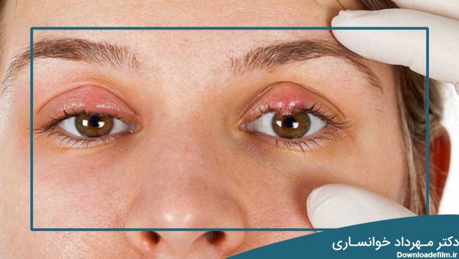 علت کیست چشم + علائم + عوارض + درمان + عمل جراحی - دکتر مهرداد ...