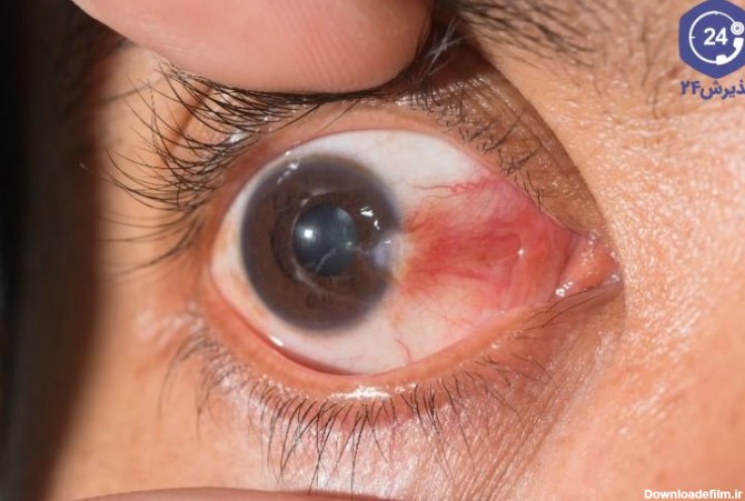 ناخنک چشم چیست؟ 14 روش خانگی برای درمان ناخنک چشم | پذیرش۲۴