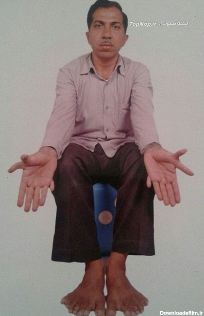 یک مرد هندی با 28 انگشت! (عکس)