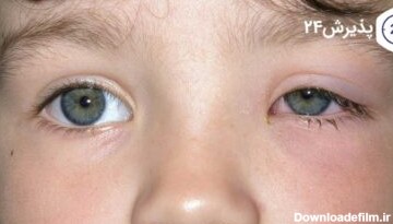 التهاب چشم کودکان چیست