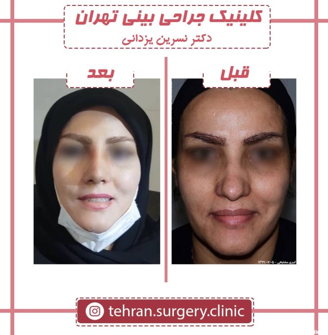 نمونه عکس قبل و بعد جراحی بینی توسط خانم دکتر نسرین یزدانی