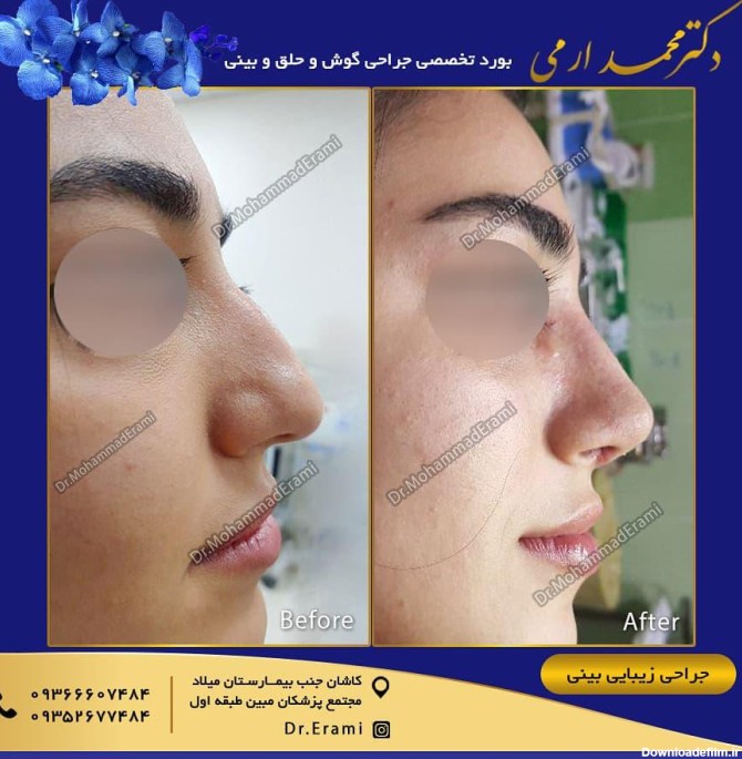 جراحی بینی طبیعی در کاشان با نتایج عالی | دکتر محمد ارمی